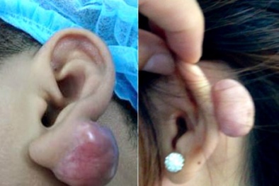 Cẩn trọng bấm lỗ tai tự hại mình